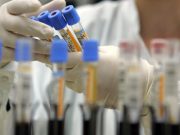 COVID-19 România | Raportul cazurilor pentru 2 Aprilie 2020 testare Raportul cazurilor pentru 2 Aprilie 2020